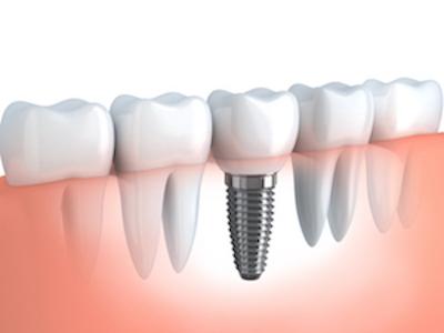 Dental Implants | McKnight Signature Dental