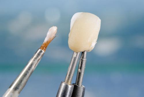 Dental Veneer | McKnight Signature Dental