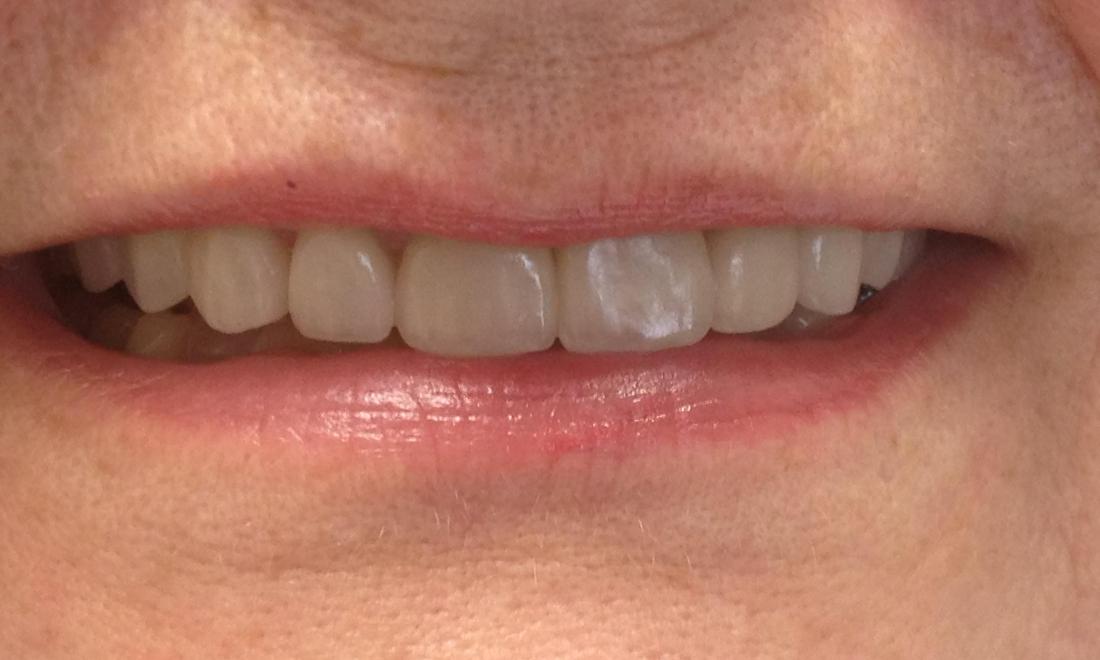 Porcelain Crown Patient After Procedure | McKnight Signature Dental