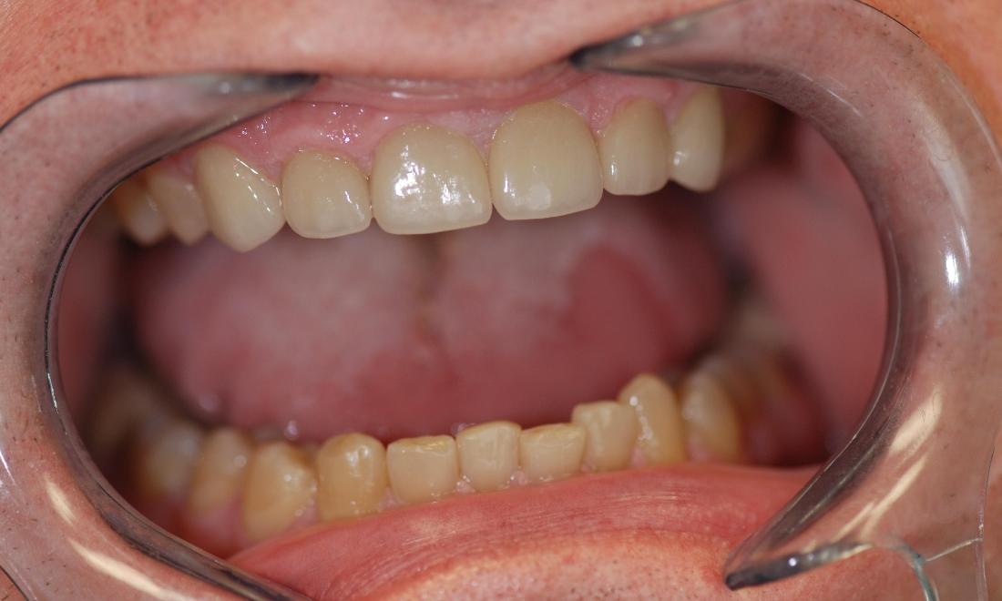 Porcelain Crowns and Composite Fillings After Surgery | McKnight Signature Dental