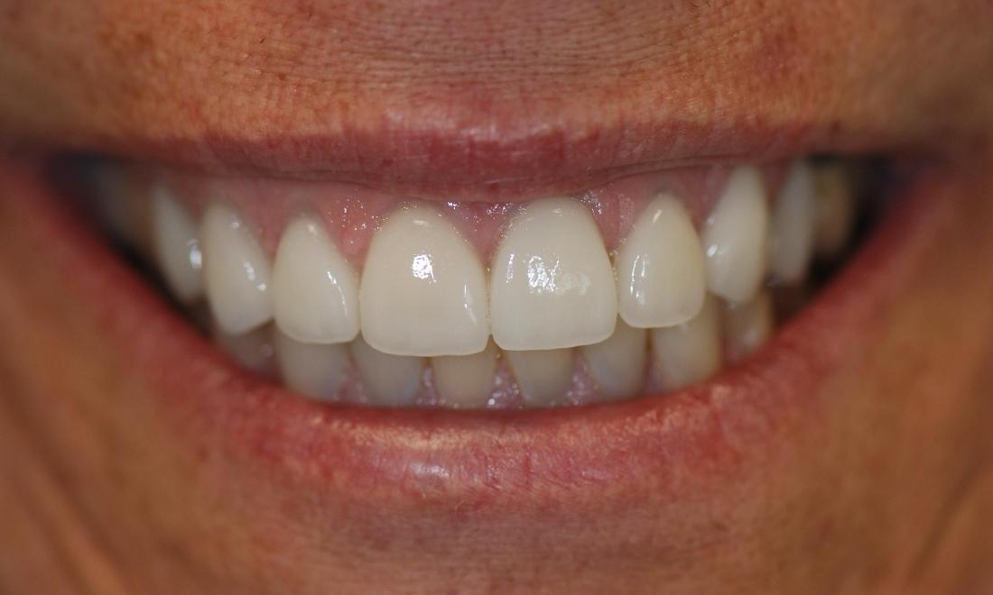 Porcelain Veneers After Surgery | McKnight Signature Dental