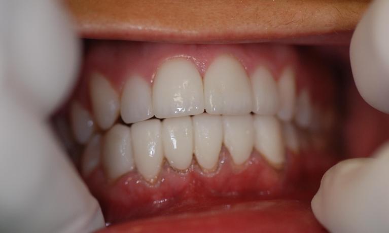 Porcelain-Veneers-After-Image