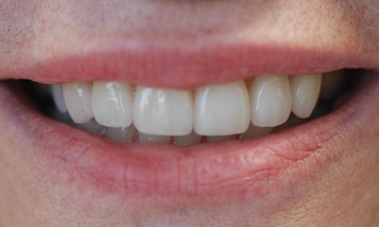 Porcelain-Veneers-After-Image