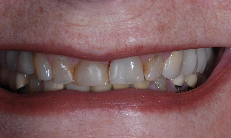 Porcelain-Crowns-Before-Image