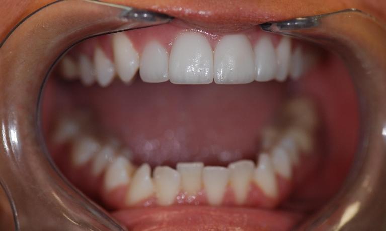 Porcelain-Veneers-Before-Image