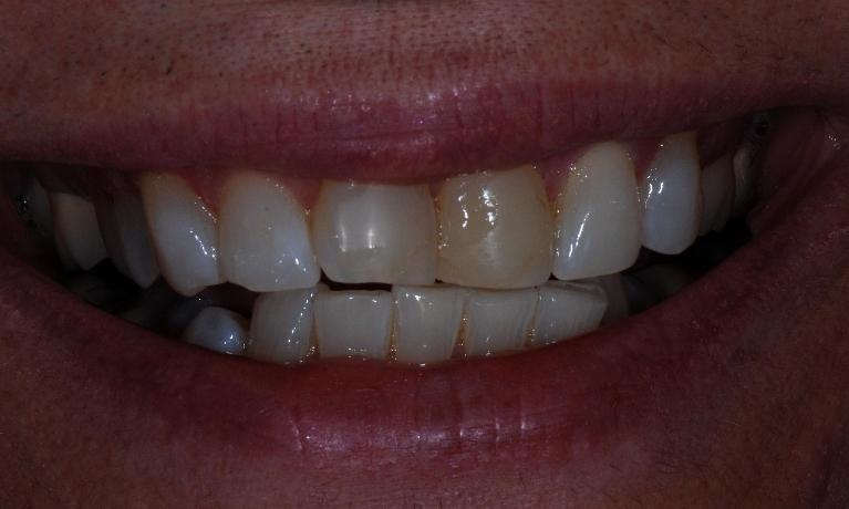 Porcelain-Veneers-Before-Image